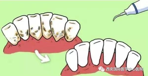 【科普】牙齿上的黄斑好难看，三招告诉你如何预防氟斑牙