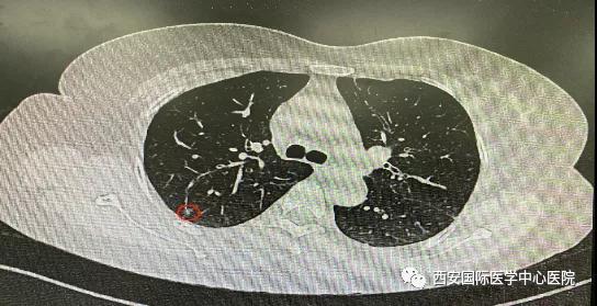 胸科医院完成西北地区首例“Lung Pro全肺诊疗导航系统联合单孔胸腔镜下右肺上叶后段切除术”