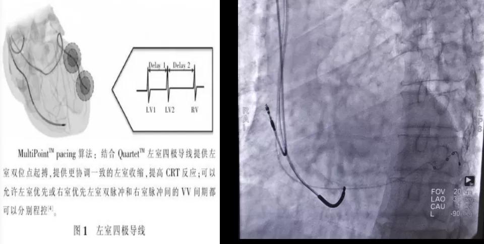 心脏病医院心脏内科首例心脏再同步治疗除颤器（MPP-D）植入成功