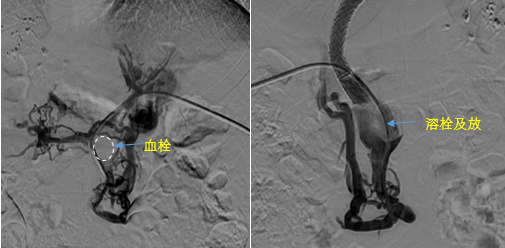 血栓拦路，如何破局——罕见巨大门静脉血栓TIPS手术实录