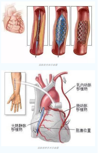 鱼与熊掌不可兼得？冠脉杂交手术一站式解决问题