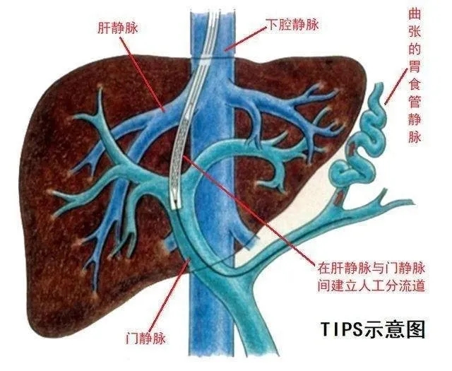 tips手术步骤的图片图片